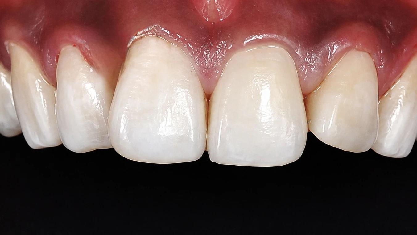 Smile after restorative dental treatment